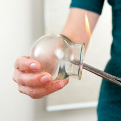 Glass cupping instruments are being held demonstrating creating a vacuum by lighting a small fire inside the cup.