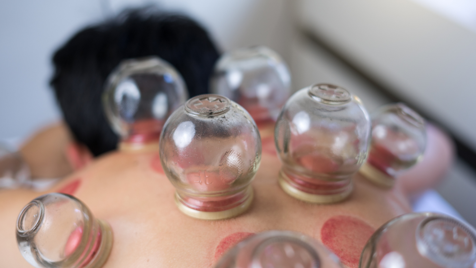 A person with short black hair with cupping cups on their back